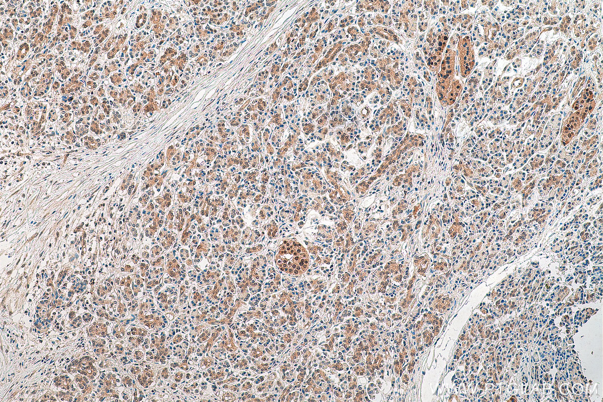 Immunohistochemistry (IHC) staining of human pancreas cancer tissue using PIN1 Polyclonal antibody (10495-1-AP)