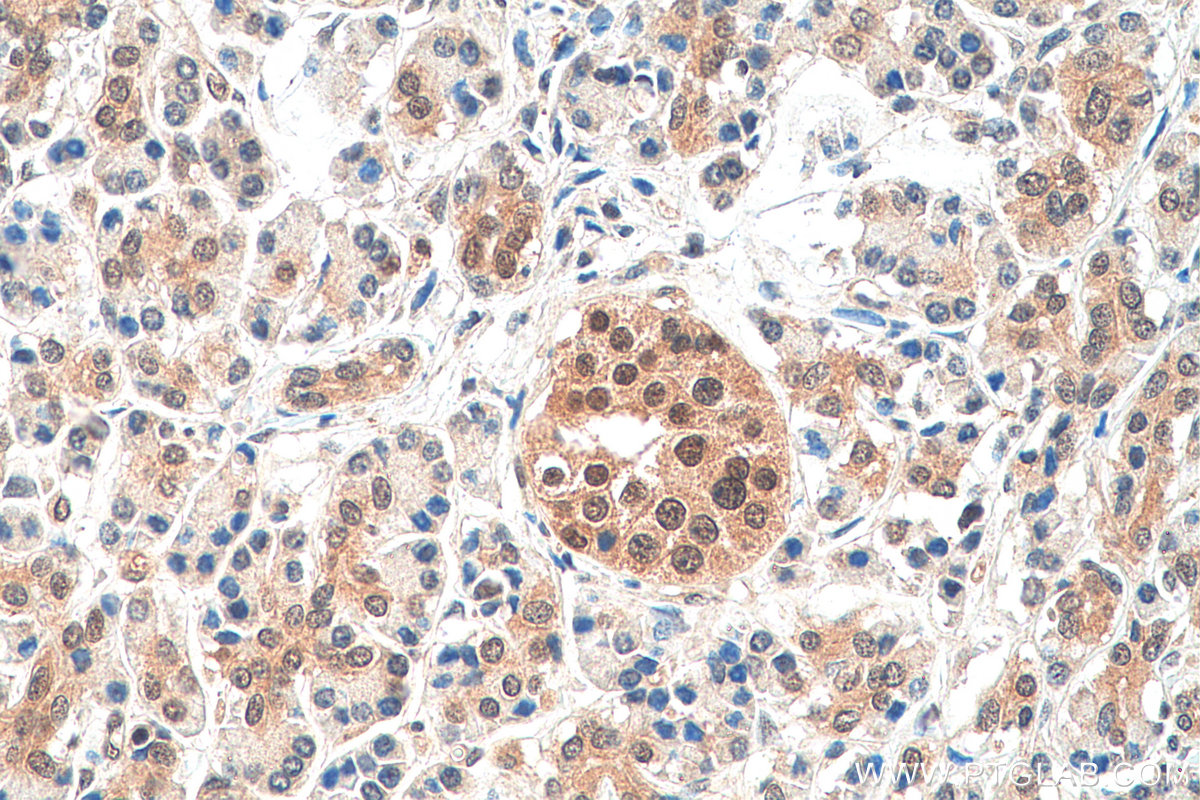 Immunohistochemistry (IHC) staining of human pancreas cancer tissue using PIN1 Polyclonal antibody (10495-1-AP)