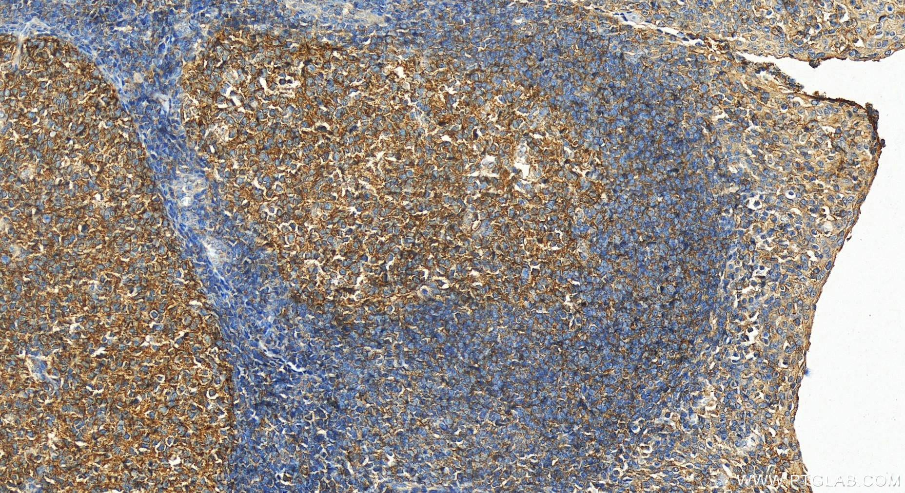 Immunohistochemistry (IHC) staining of human tonsillitis tissue using PIP5K1A Polyclonal antibody (15713-1-AP)