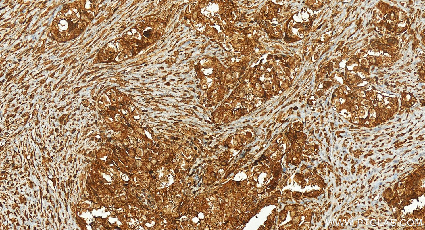 Immunohistochemistry (IHC) staining of human ovary cancer tissue using PKC Zeta Polyclonal antibody (26899-1-AP)