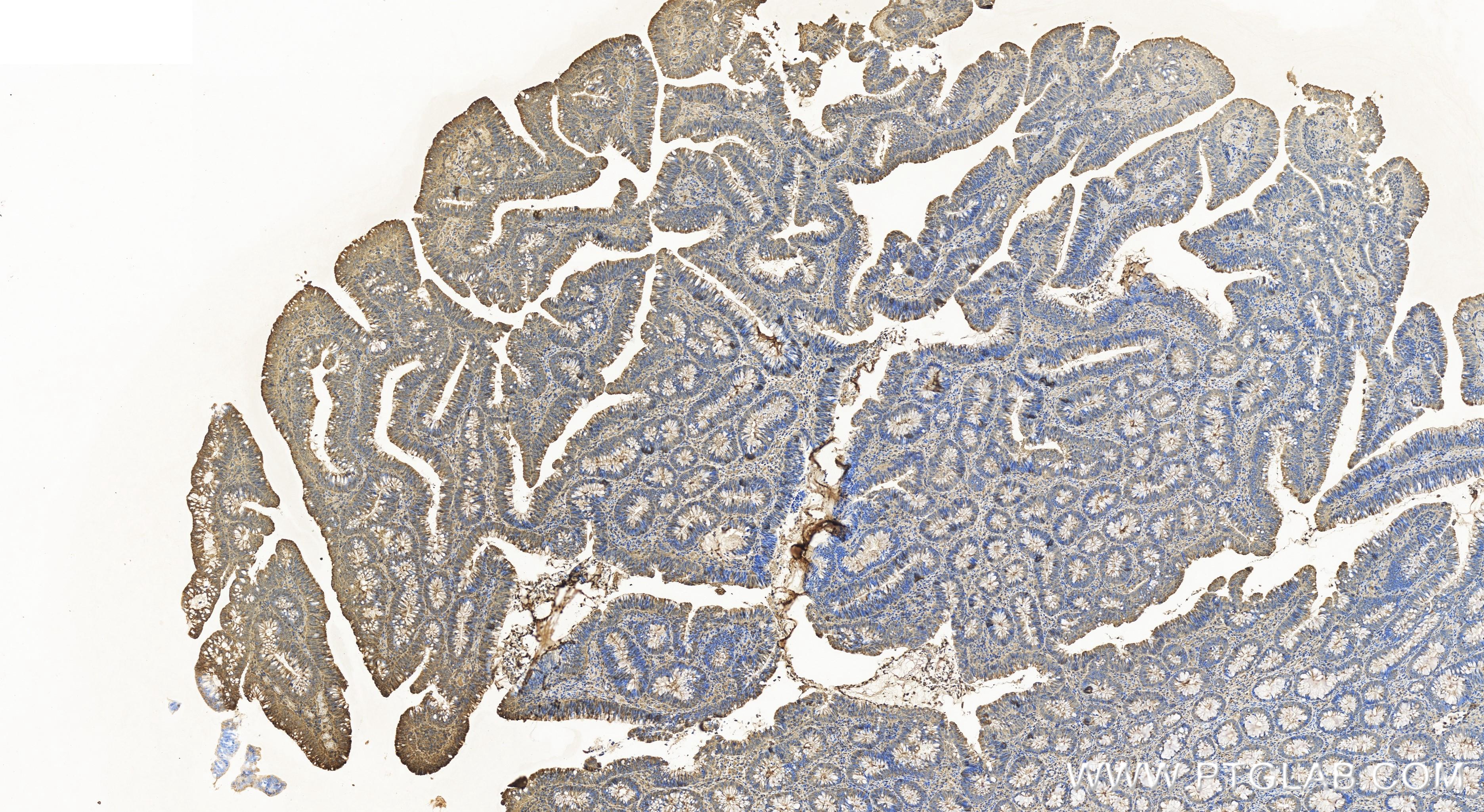 Immunohistochemistry (IHC) staining of human colon cancer tissue using PKM2-specific Recombinant antibody (84451-1-RR)