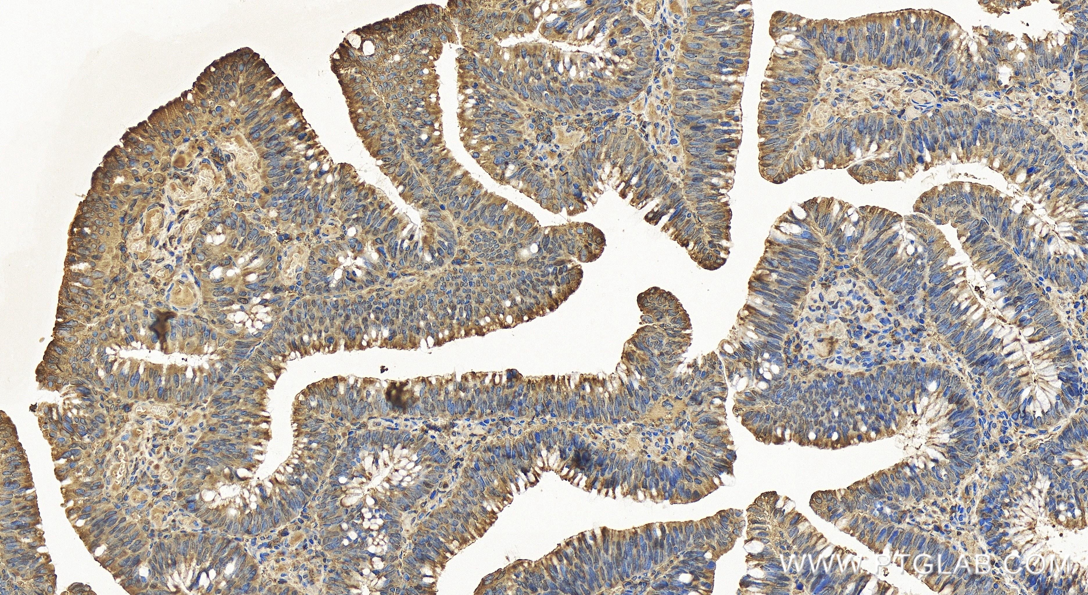 Immunohistochemistry (IHC) staining of human colon cancer tissue using PKM2-specific Recombinant antibody (84451-1-RR)