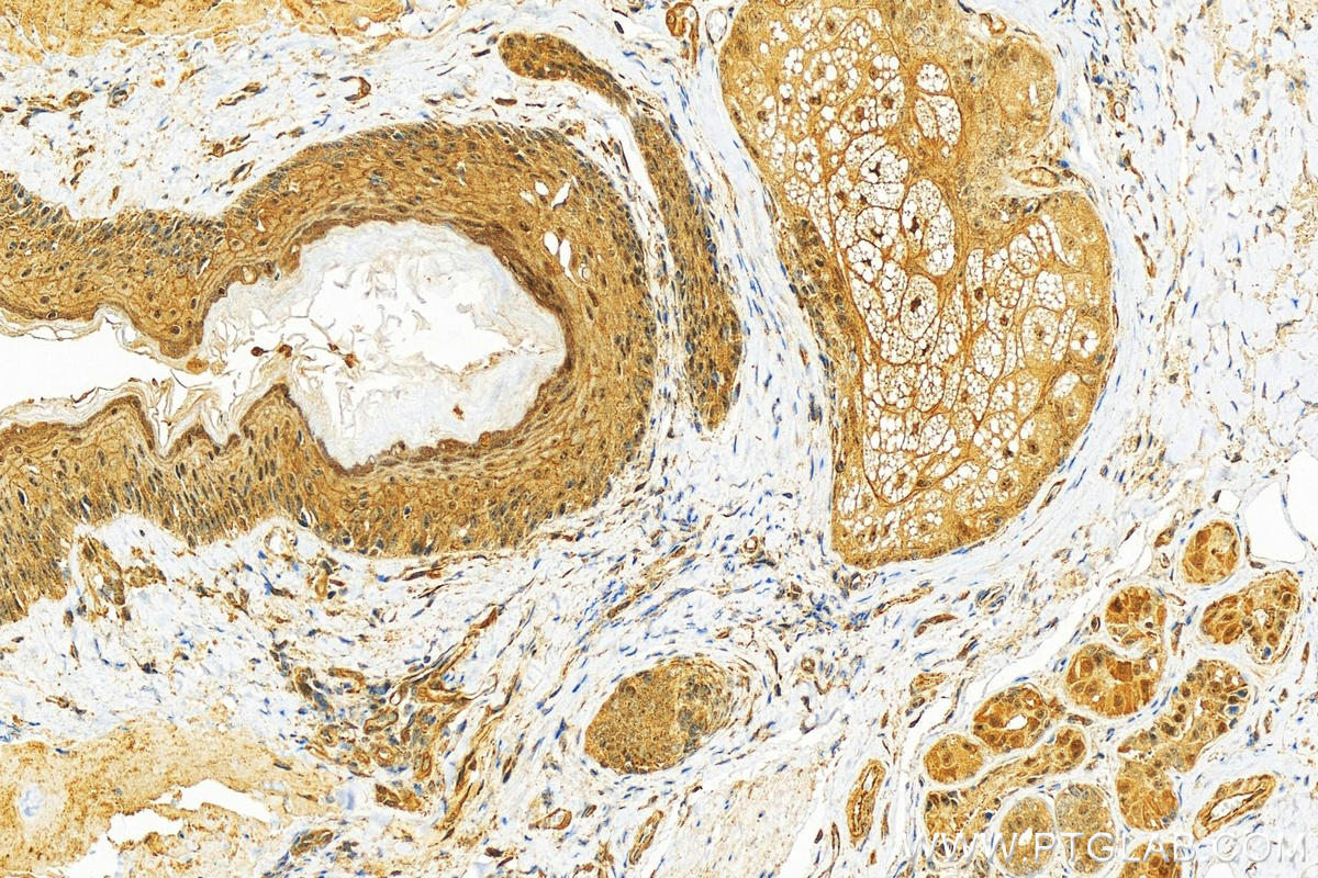 Immunohistochemistry (IHC) staining of human skin cancer tissue using PKP1 Polyclonal antibody (22632-1-AP)