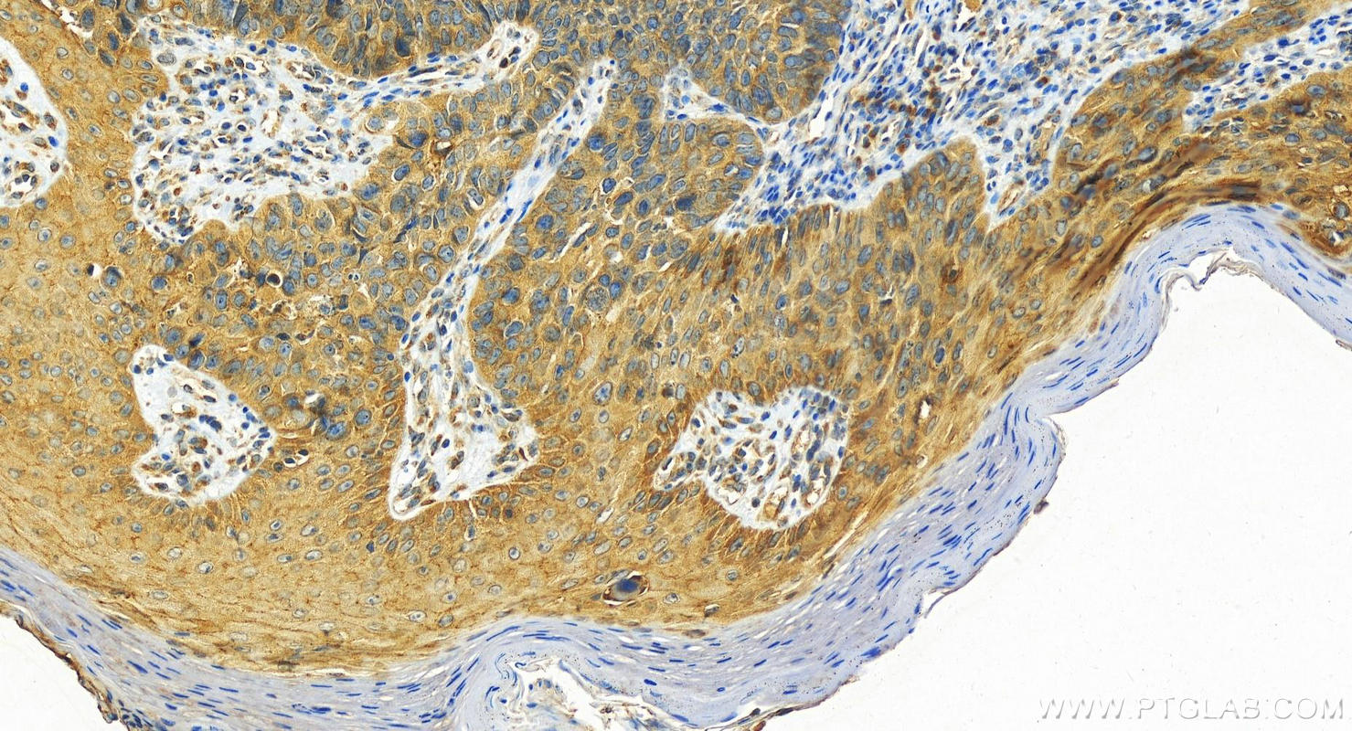 Immunohistochemistry (IHC) staining of human bowen disease using Plakophilin 3 Polyclonal antibody (18338-1-AP)