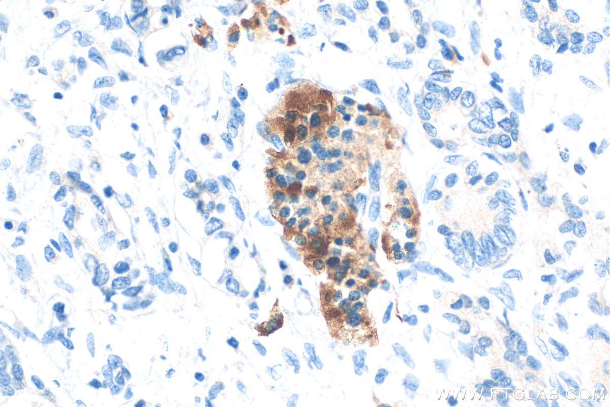 Immunohistochemistry (IHC) staining of human pancreas cancer tissue using PLA2G1B Polyclonal antibody (15843-1-AP)
