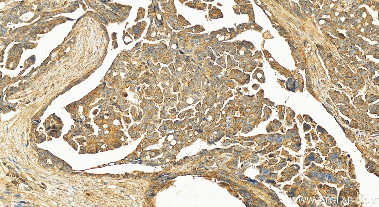 Immunohistochemistry (IHC) staining of human ovary cancer tissue using PLAC1L Polyclonal antibody (17343-1-AP)