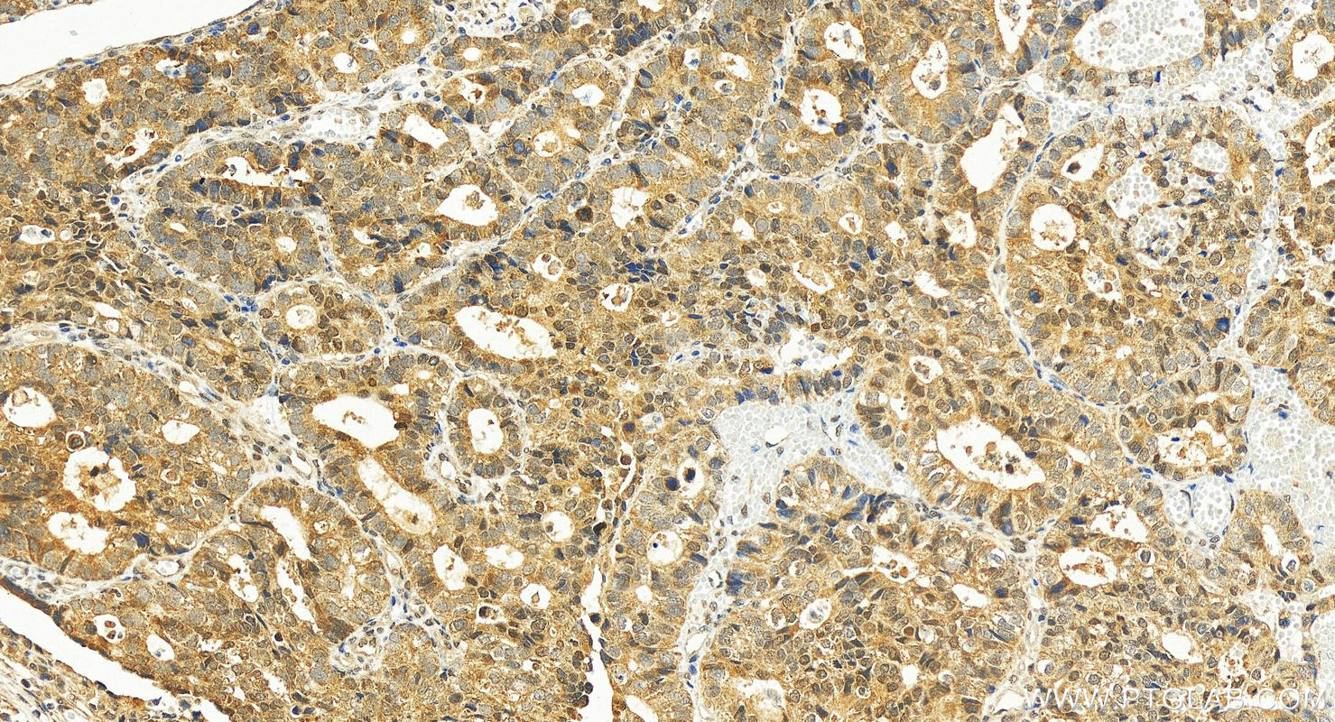 Immunohistochemistry (IHC) staining of human stomach cancer tissue using PLAGL1 Polyclonal antibody (25864-1-AP)