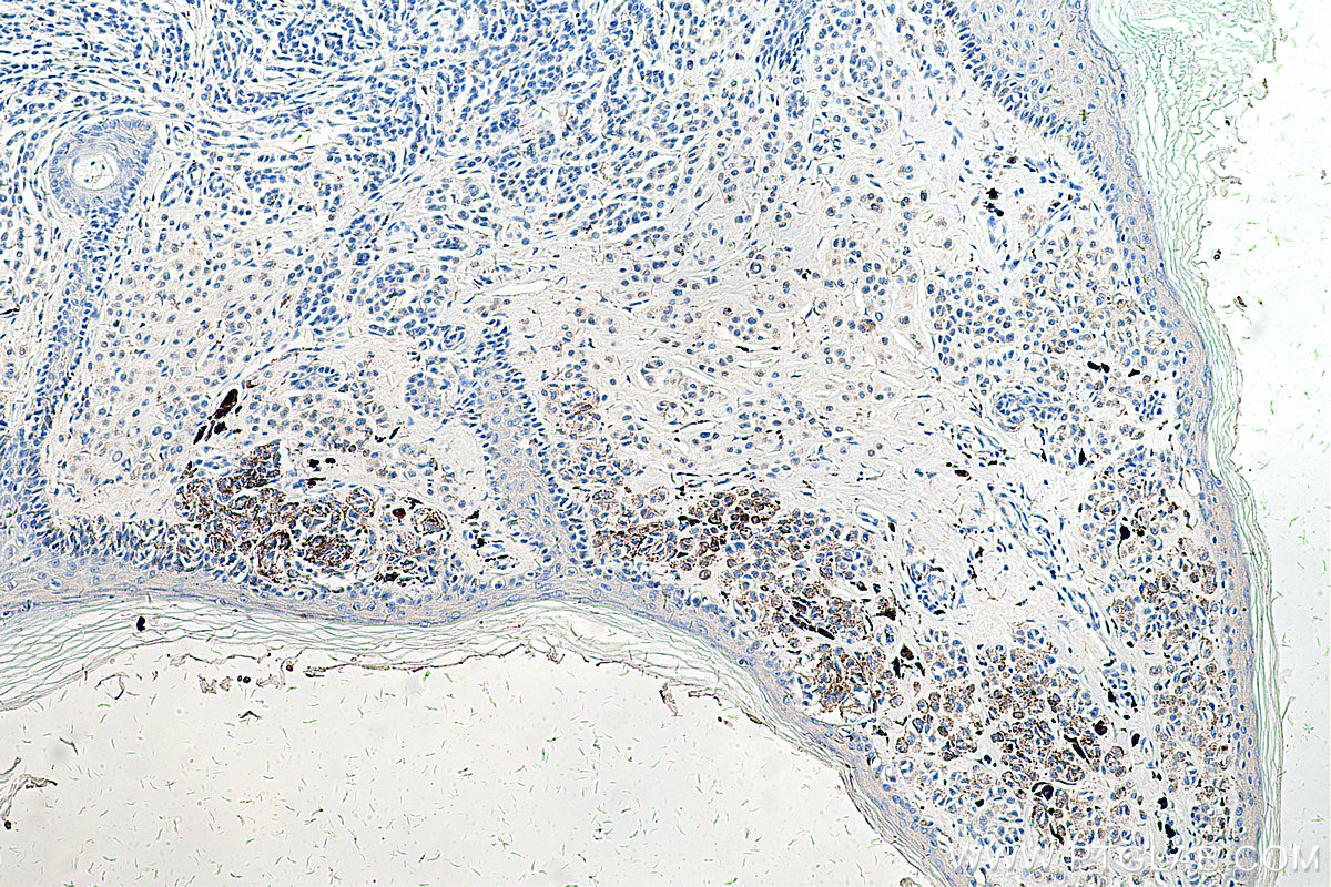 Immunohistochemistry (IHC) staining of human malignant melanoma tissue using PLAP Monoclonal antibody (60294-1-Ig)