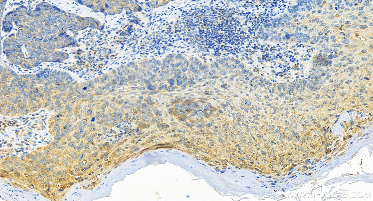 Immunohistochemistry (IHC) staining of human bowen disease using uPA/Urokinase Polyclonal antibody (17968-1-AP)