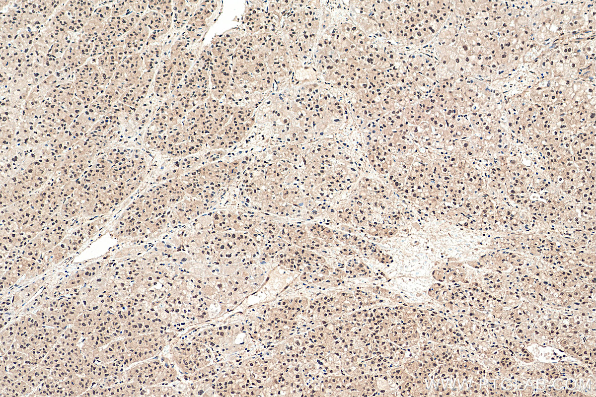 Immunohistochemistry (IHC) staining of human liver cancer tissue using PLK3 Polyclonal antibody (10977-1-AP)