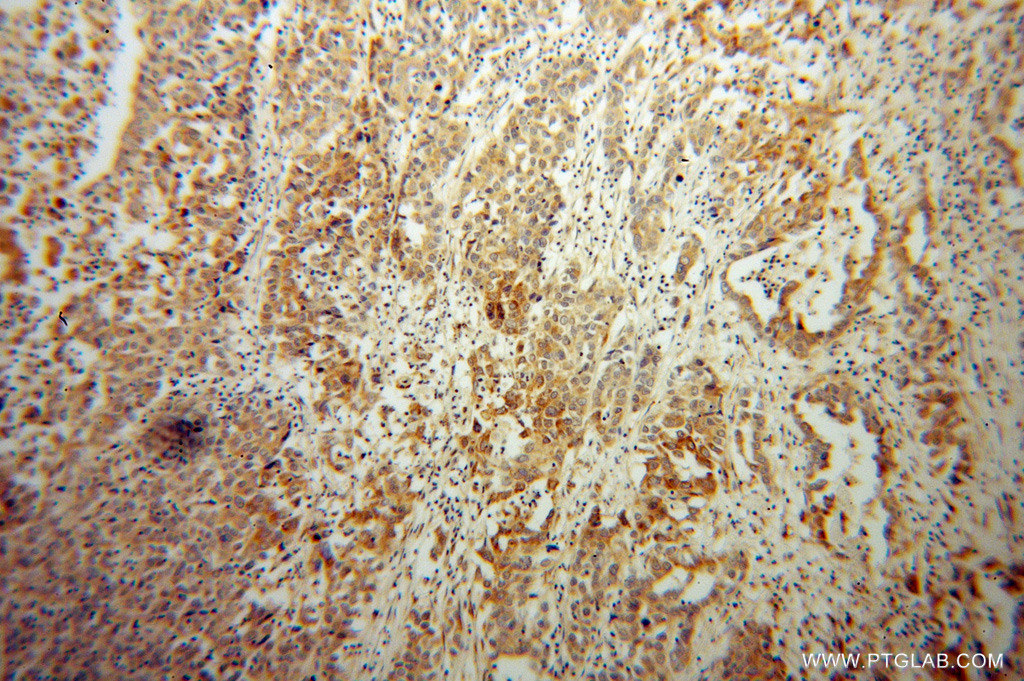 Immunohistochemistry (IHC) staining of human pancreas cancer tissue using PLOD2 Polyclonal antibody (13453-1-AP)