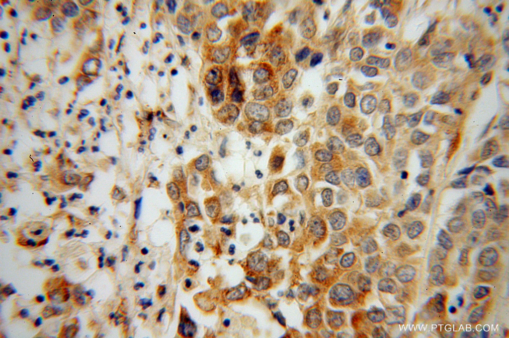 Immunohistochemistry (IHC) staining of human pancreas cancer tissue using PLOD2 Polyclonal antibody (13453-1-AP)