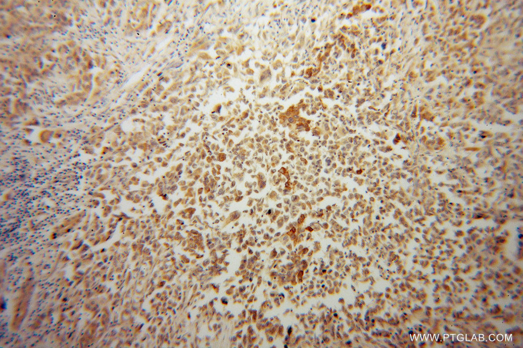 Immunohistochemistry (IHC) staining of human pancreas cancer tissue using PLOD2 Polyclonal antibody (13453-1-AP)