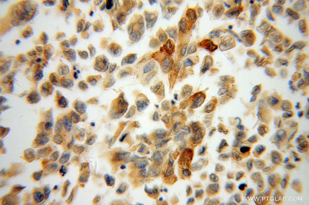 Immunohistochemistry (IHC) staining of human pancreas cancer tissue using PLOD2 Polyclonal antibody (13453-1-AP)