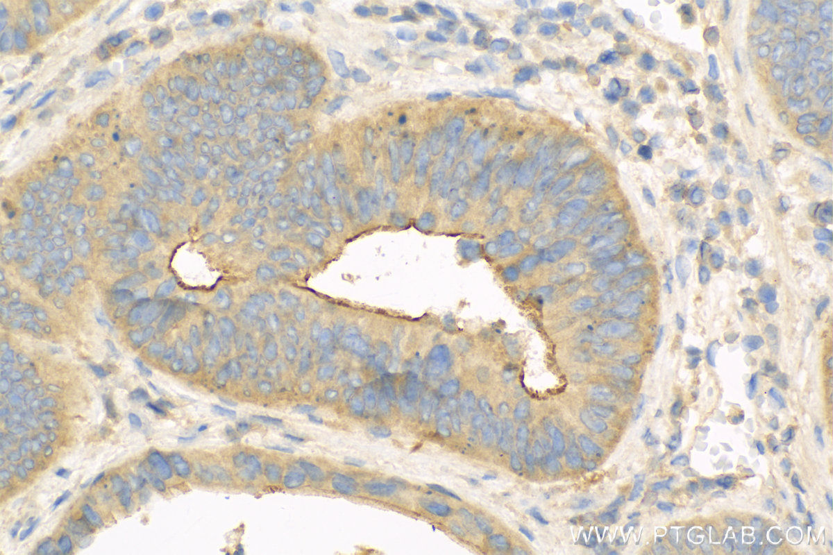 Immunohistochemistry (IHC) staining of Human Colon cancer tissue using PLS1 Polyclonal antibody (13143-1-AP)