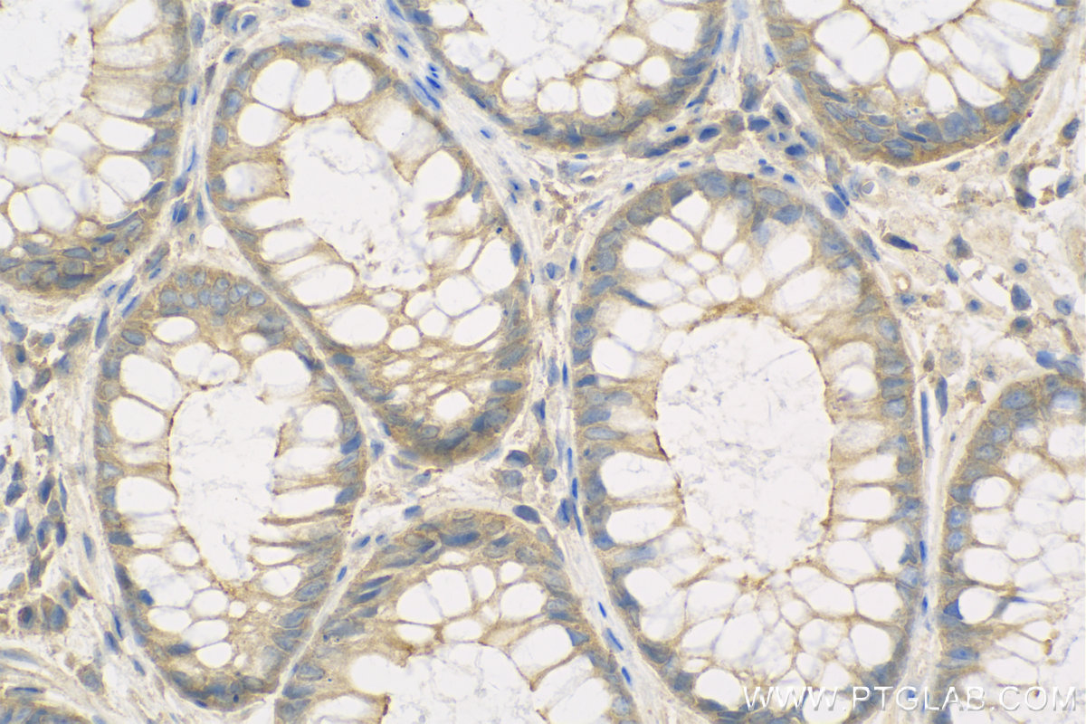 Immunohistochemistry (IHC) staining of Human Colon cancer tissue using PLS1 Polyclonal antibody (13143-1-AP)