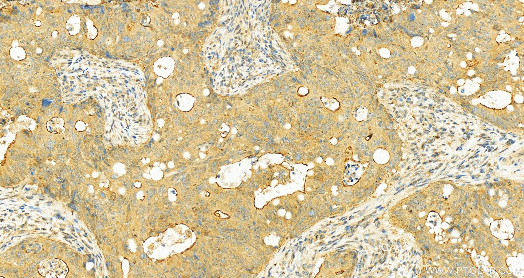 Immunohistochemistry (IHC) staining of human colon cancer tissue using PLS1 Polyclonal antibody (55212-1-AP)