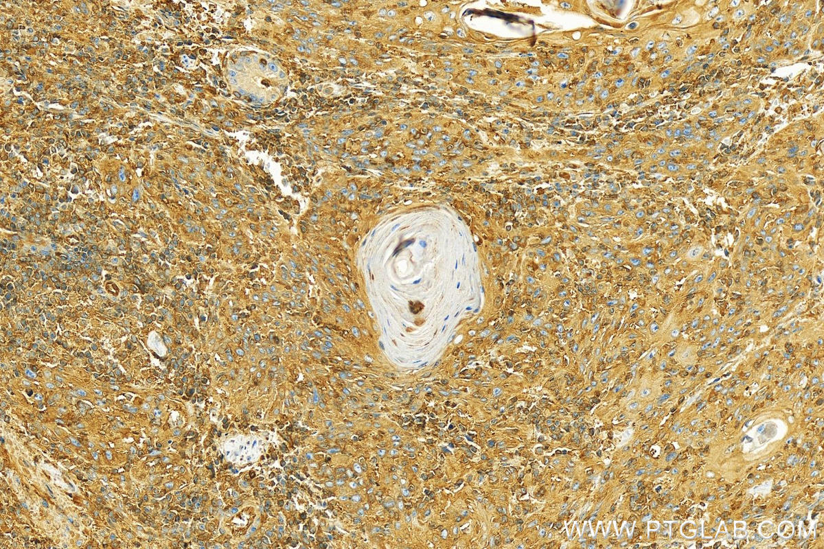 Immunohistochemistry (IHC) staining of human skin cancer tissue using PLS3 Polyclonal antibody (12917-1-AP)