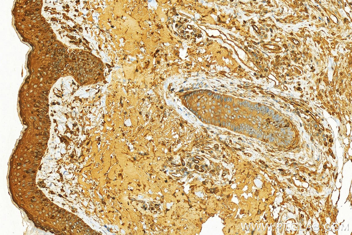 Immunohistochemistry (IHC) staining of human skin cancer tissue using PLS3 Polyclonal antibody (12917-1-AP)