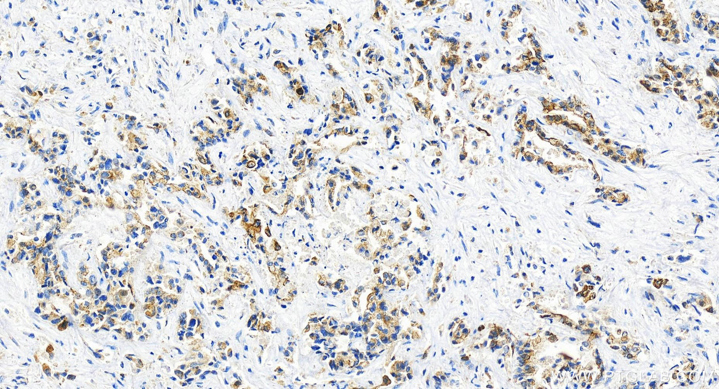 Immunohistochemistry (IHC) staining of human intrahepatic cholangiocarcinoma tissue using PLXDC2 Recombinant antibody (83449-4-RR)