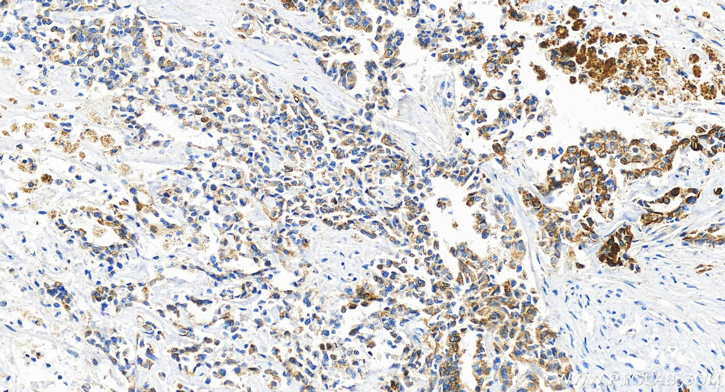 Immunohistochemistry (IHC) staining of human intrahepatic cholangiocarcinoma tissue using PLXDC2 Recombinant antibody (83449-4-RR)