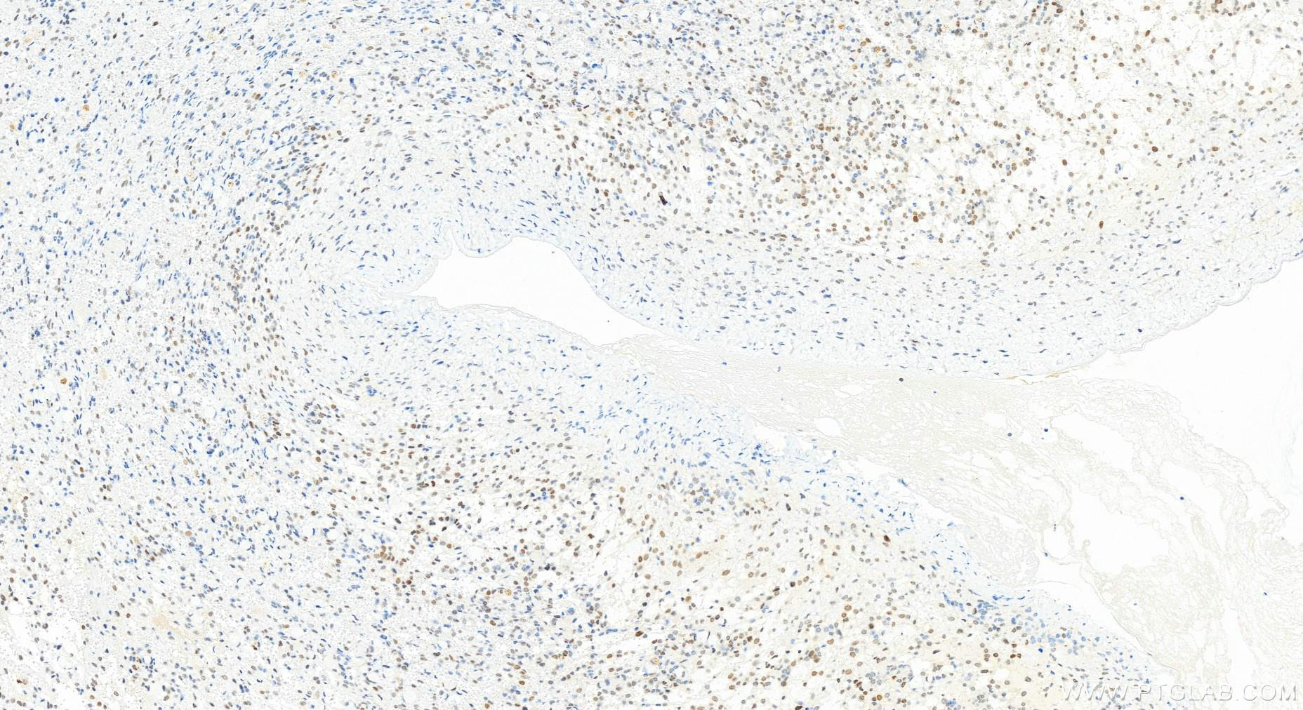 Immunohistochemistry (IHC) staining of human ovary cancer tissue using PMS1 Recombinant antibody (83456-6-RR)