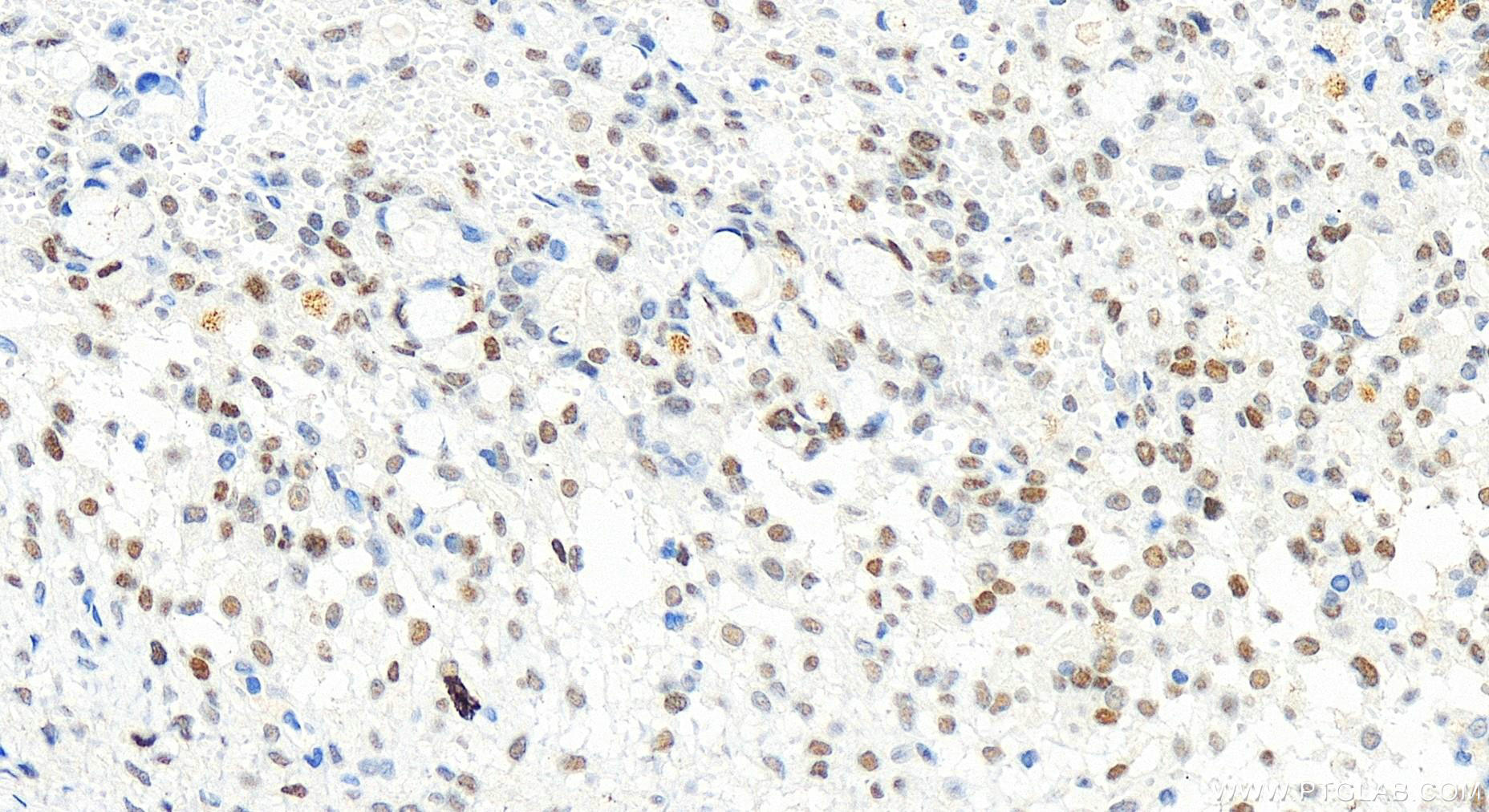 Immunohistochemistry (IHC) staining of human ovary cancer tissue using PMS1 Recombinant antibody (83456-6-RR)