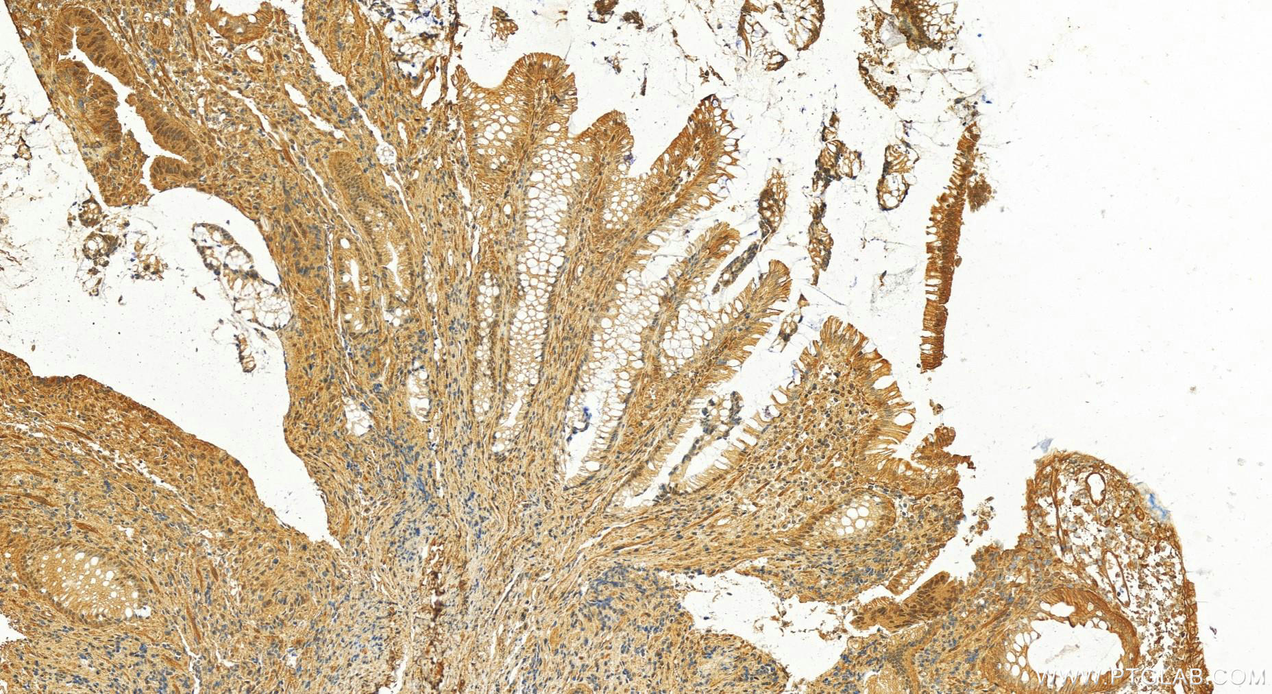 Immunohistochemistry (IHC) staining of human colon  cancer using PMS2 Polyclonal antibody (18164-1-AP)