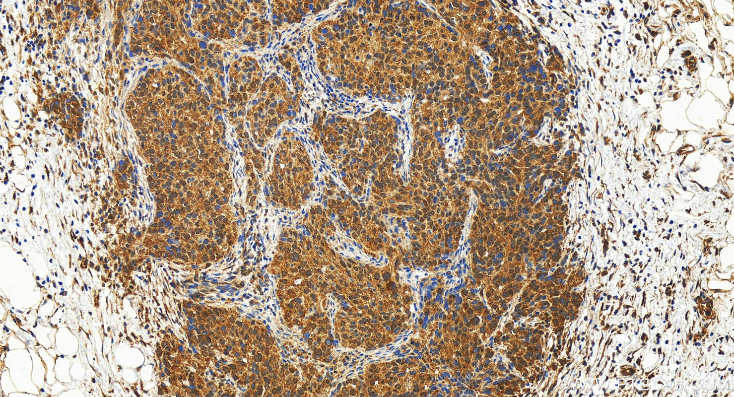 Immunohistochemistry (IHC) staining of human ovary cancer tissue using PMS2 Polyclonal antibody (18164-1-AP)