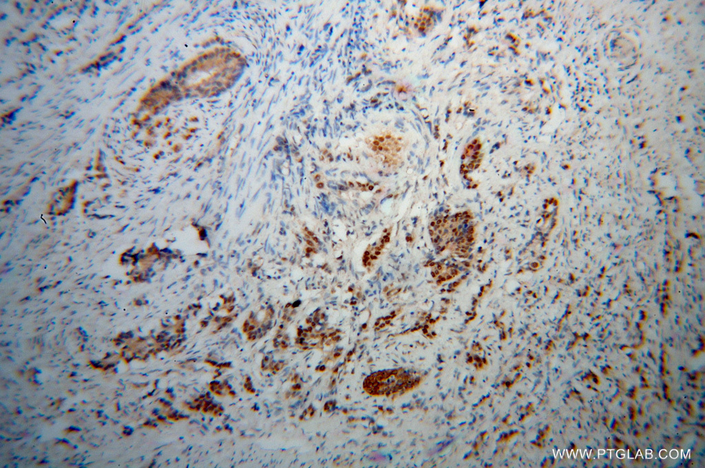 Immunohistochemistry (IHC) staining of human gliomas tissue using PNRC2 Polyclonal antibody (51050-1-AP)