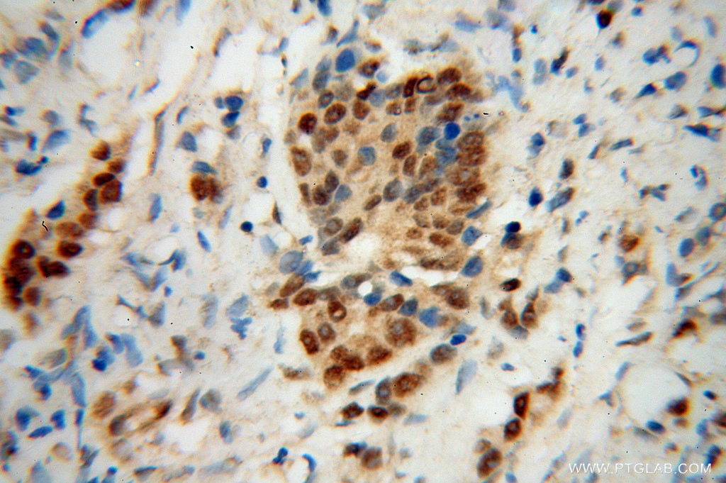 Immunohistochemistry (IHC) staining of human gliomas tissue using PNRC2 Polyclonal antibody (51050-1-AP)