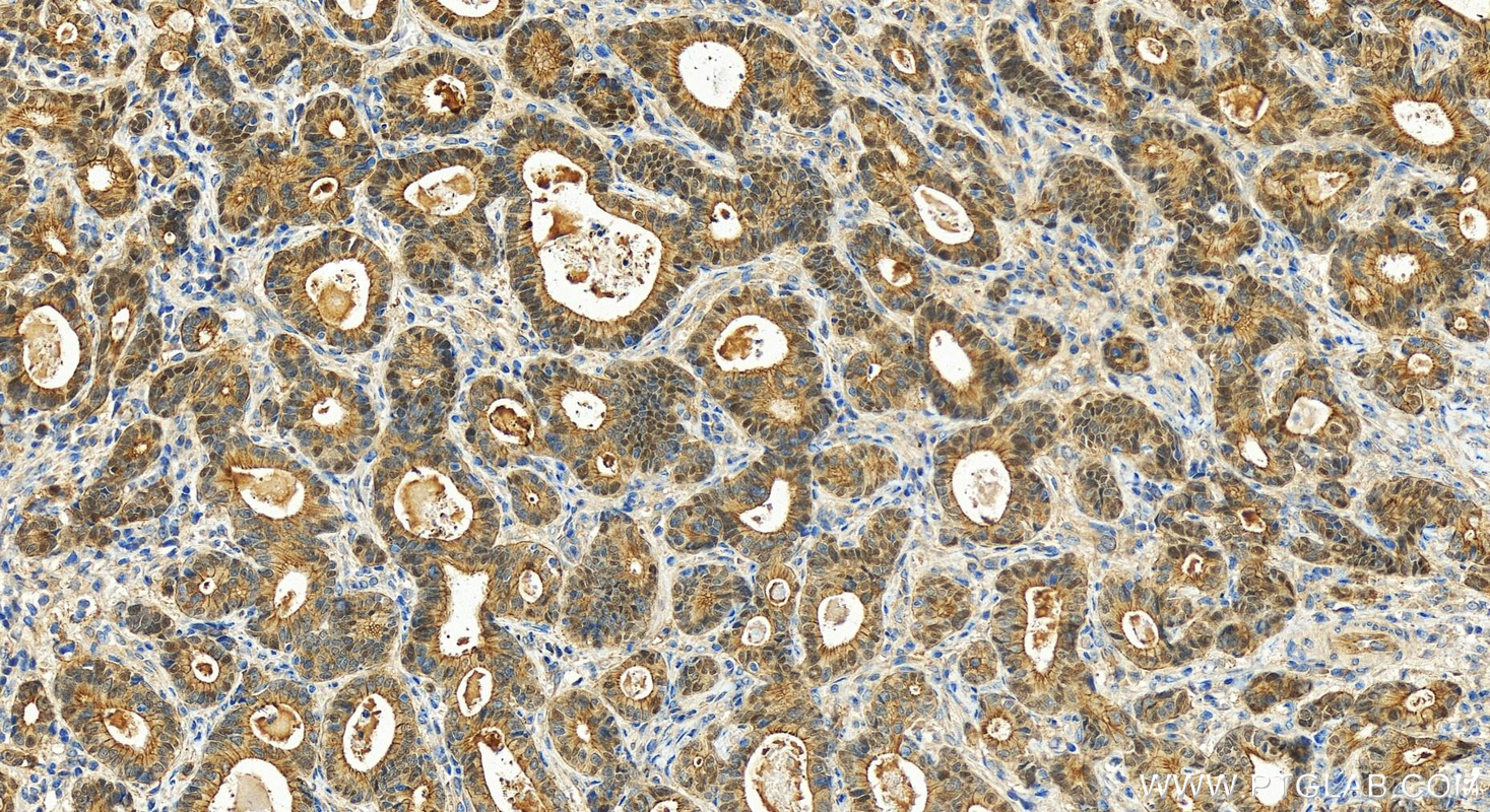 Immunohistochemistry (IHC) staining of human stomach cancer tissue using POF1B Polyclonal antibody (11398-1-AP)