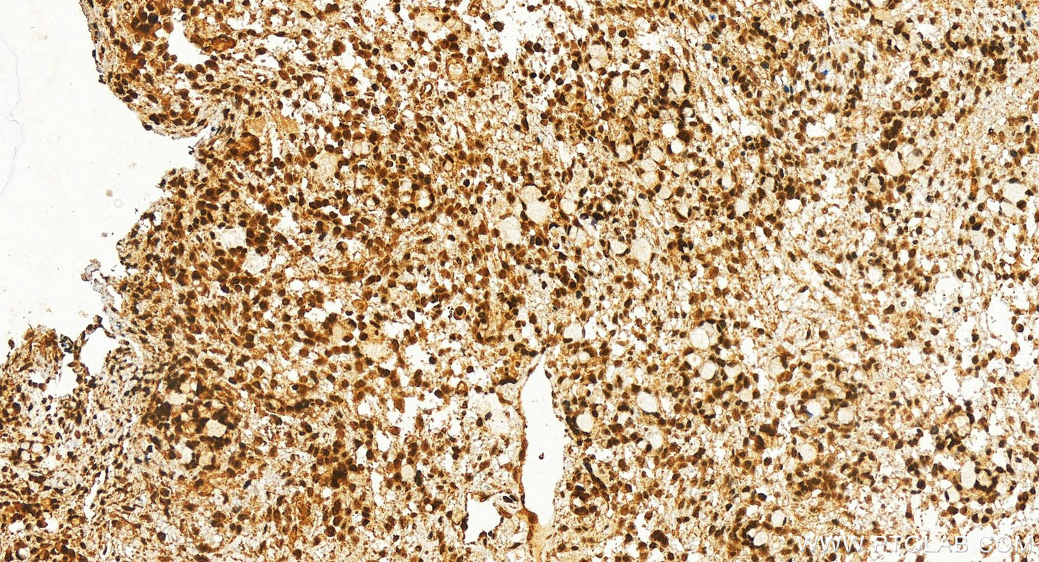 Immunohistochemistry (IHC) staining of human ovary cancer tissue using POLR1D Polyclonal antibody (16678-1-AP)