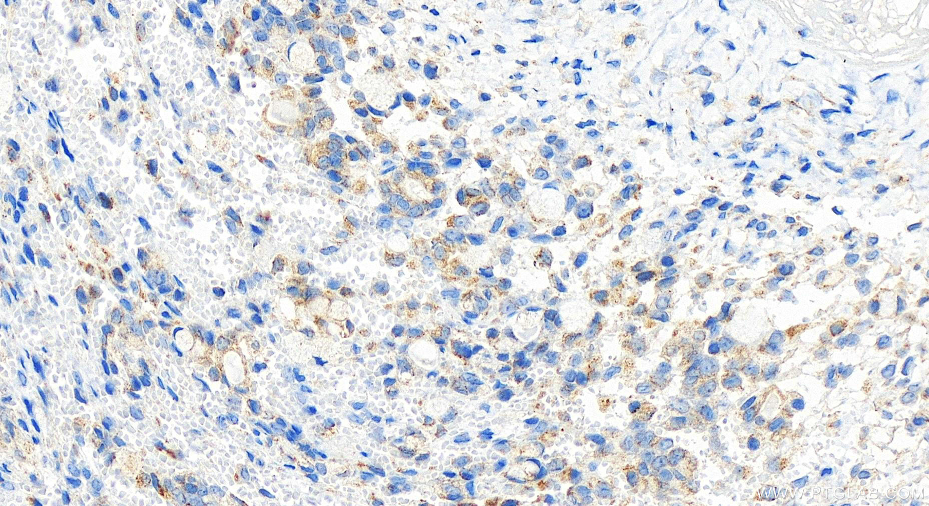 Immunohistochemistry (IHC) staining of human ovary cancer tissue using POLRMT Polyclonal antibody (17748-1-AP)