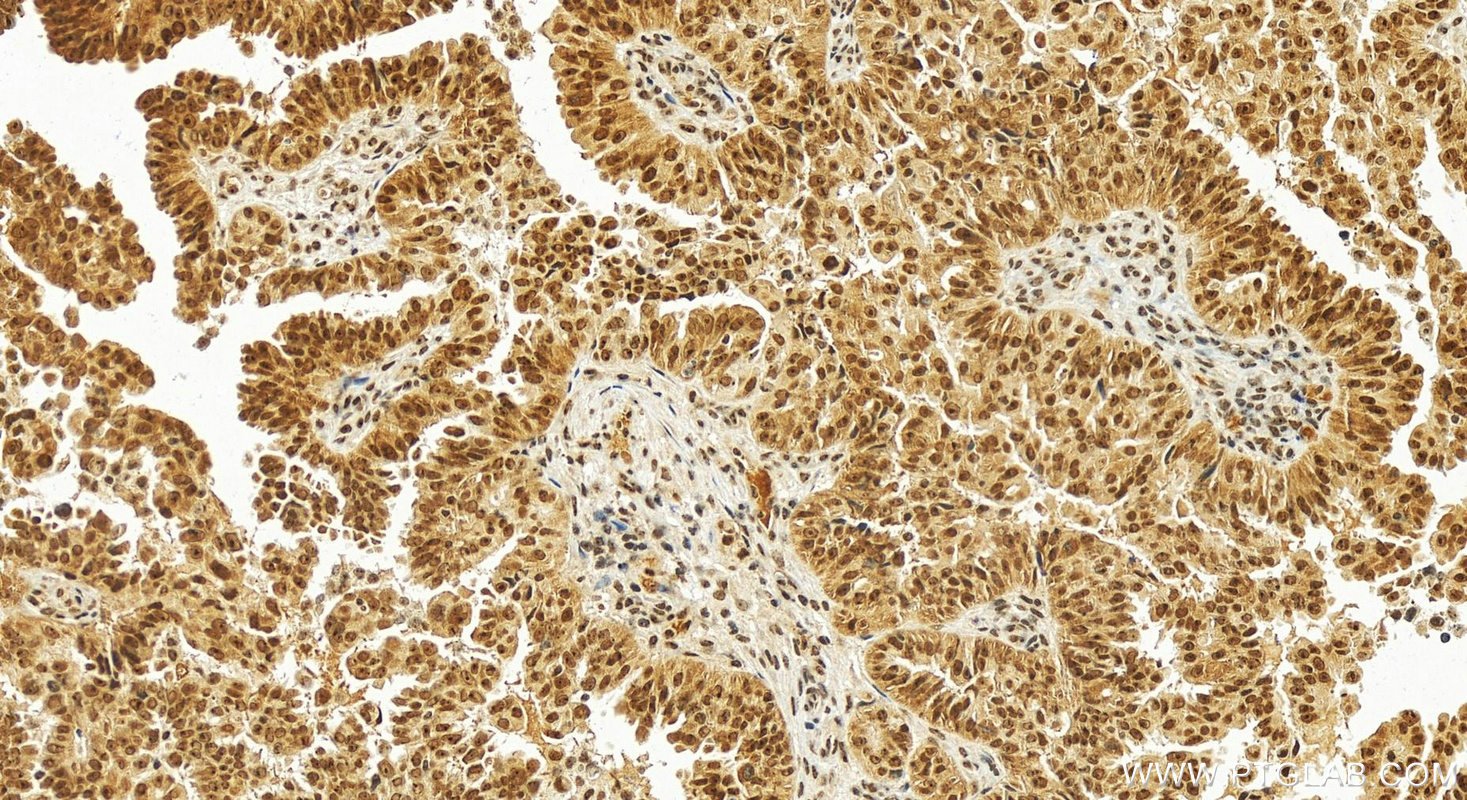 Immunohistochemistry (IHC) staining of human ovary cancer tissue using POP1 Polyclonal antibody (12029-1-AP)