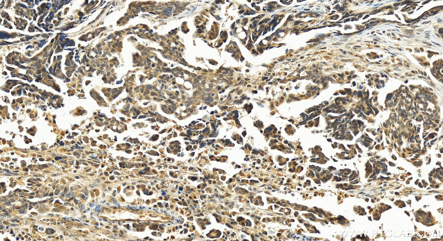 Immunohistochemistry (IHC) staining of human ovary cancer tissue using POTEA Polyclonal antibody (24593-1-AP)