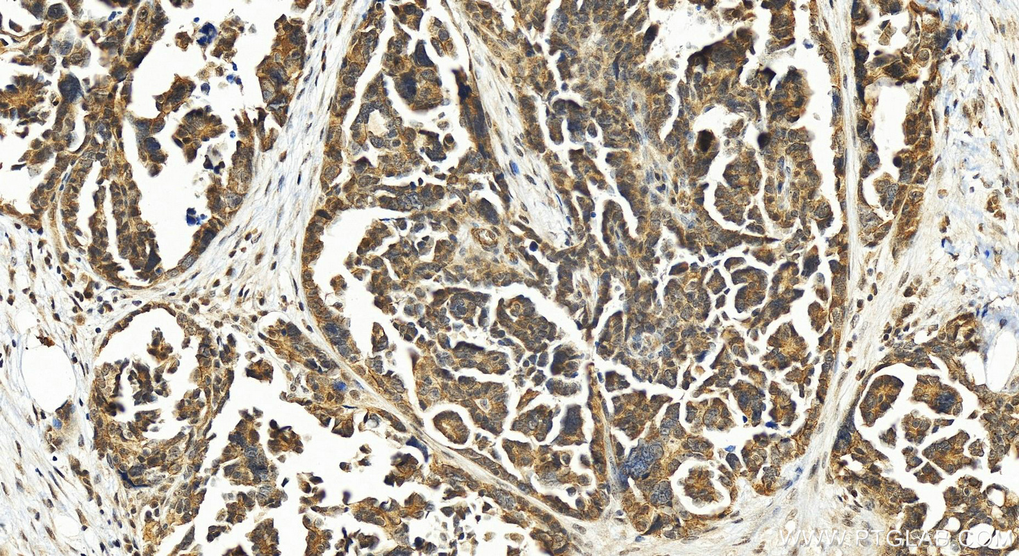 Immunohistochemistry (IHC) staining of human ovary cancer tissue using POTEA Polyclonal antibody (24593-1-AP)