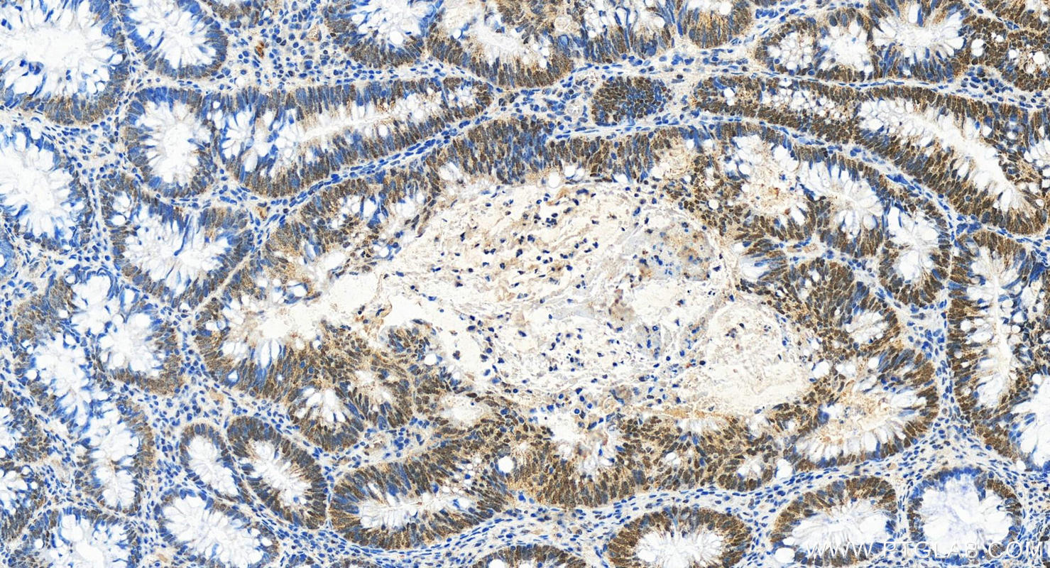 Immunohistochemistry (IHC) staining of human colon cancer tissue using OCT1 Polyclonal antibody (10387-1-AP)