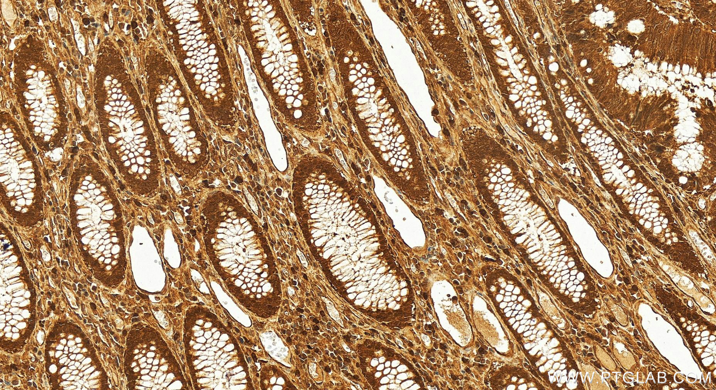 Immunohistochemistry (IHC) staining of human colon cancer tissue using PPAR Gamma Polyclonal antibody (16643-1-AP)