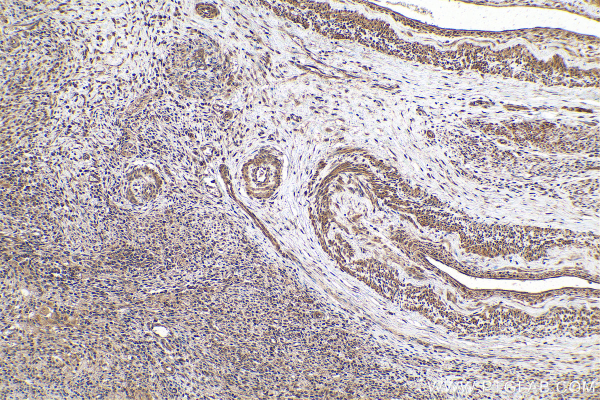 Immunohistochemistry (IHC) staining of human cervical cancer tissue using PPP1CB Polyclonal antibody (10140-2-AP)