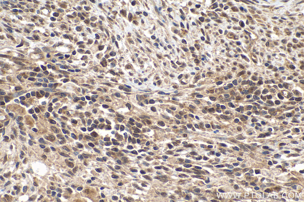 Immunohistochemistry (IHC) staining of human cervical cancer tissue using PPP1CB Polyclonal antibody (10140-2-AP)