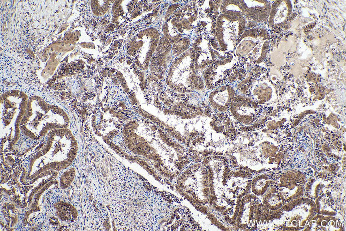 Immunohistochemistry (IHC) staining of human ovary tumor tissue using PPP1CB Polyclonal antibody (10140-2-AP)