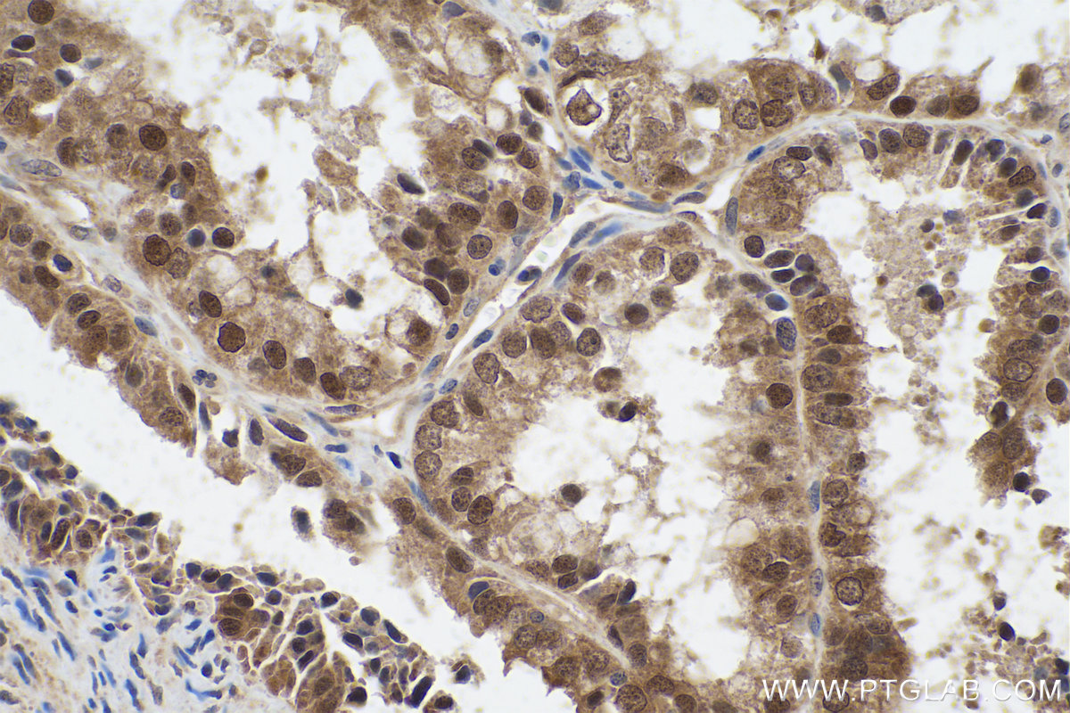 Immunohistochemistry (IHC) staining of human ovary tumor tissue using PPP1CB Polyclonal antibody (10140-2-AP)