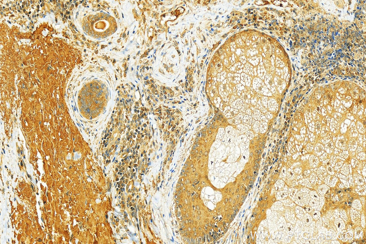 Immunohistochemistry (IHC) staining of human skin cancer tissue using PPP1CB-Specific Polyclonal antibody (55136-1-AP)