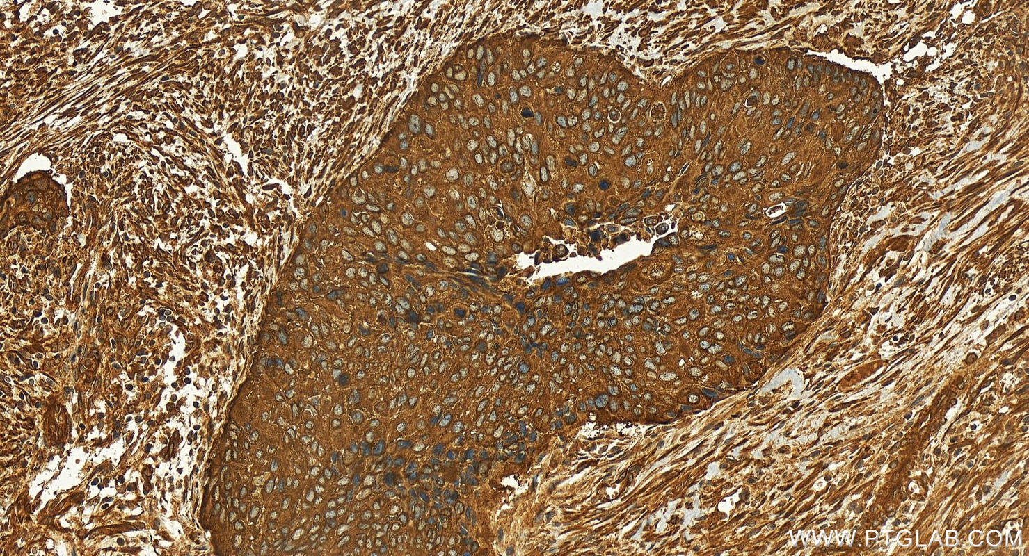 Immunohistochemistry (IHC) staining of human cervical squamous cancer tissue using iASPP Polyclonal antibody (18590-1-AP)