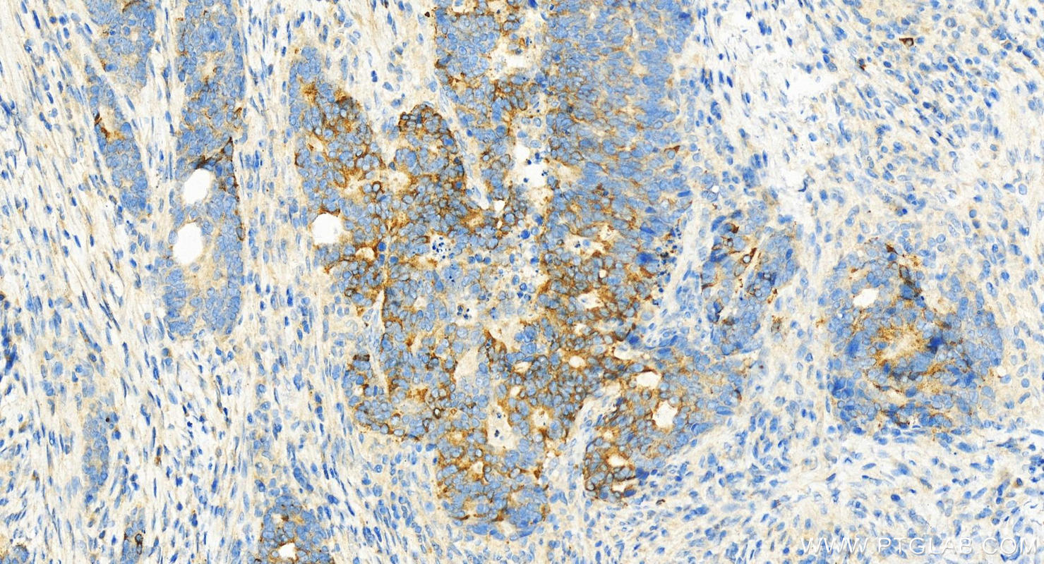 Immunohistochemistry (IHC) staining of human stomach cancer tissue using PPP1R3B Polyclonal antibody (14190-1-AP)