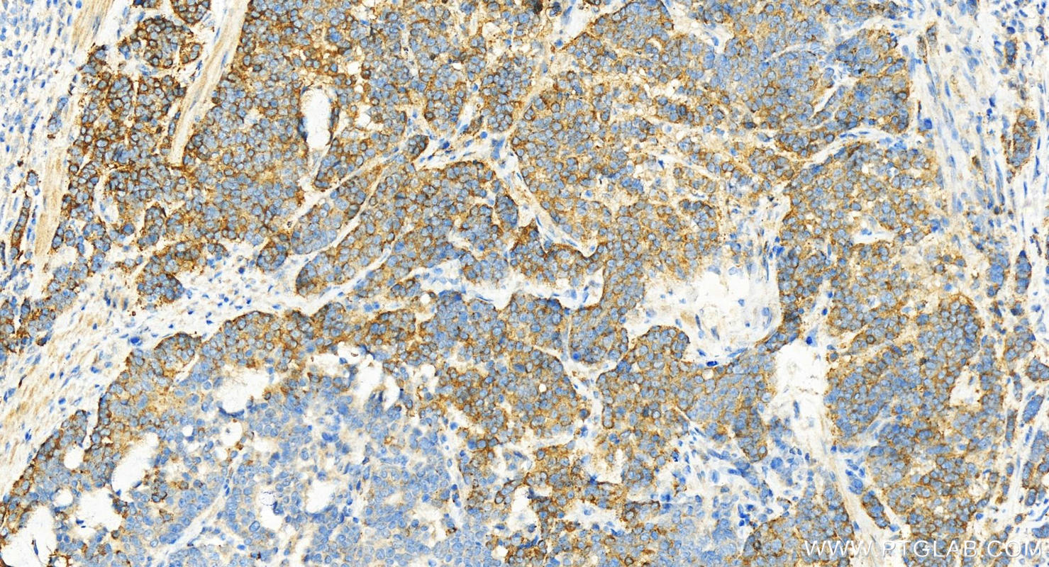 Immunohistochemistry (IHC) staining of human stomach cancer tissue using PPP1R3B Polyclonal antibody (14190-1-AP)