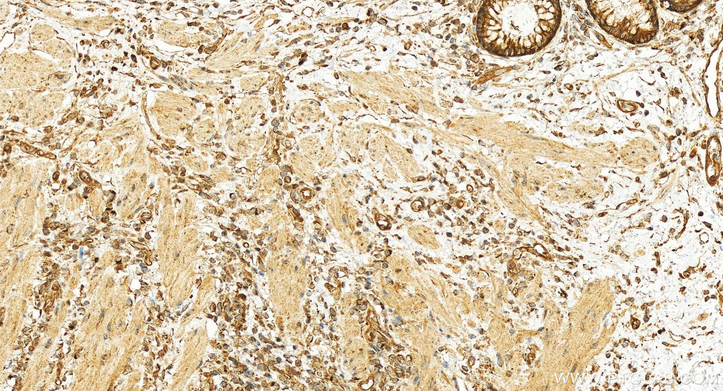 Immunohistochemistry (IHC) staining of human colon cancer tissue using PPP3CA Polyclonal antibody (13422-1-AP)