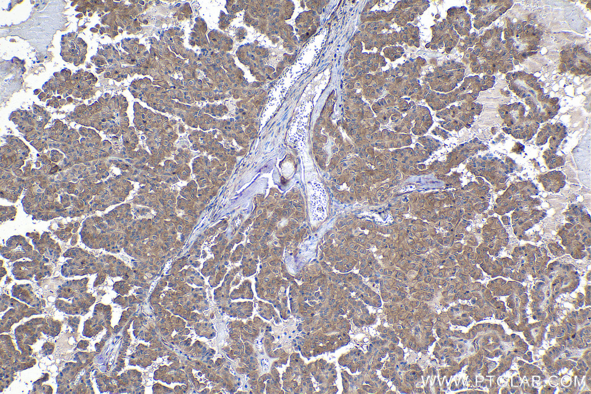 Immunohistochemistry (IHC) staining of human thyroid cancer tissue using PPP3CA Monoclonal antibody (68163-1-Ig)