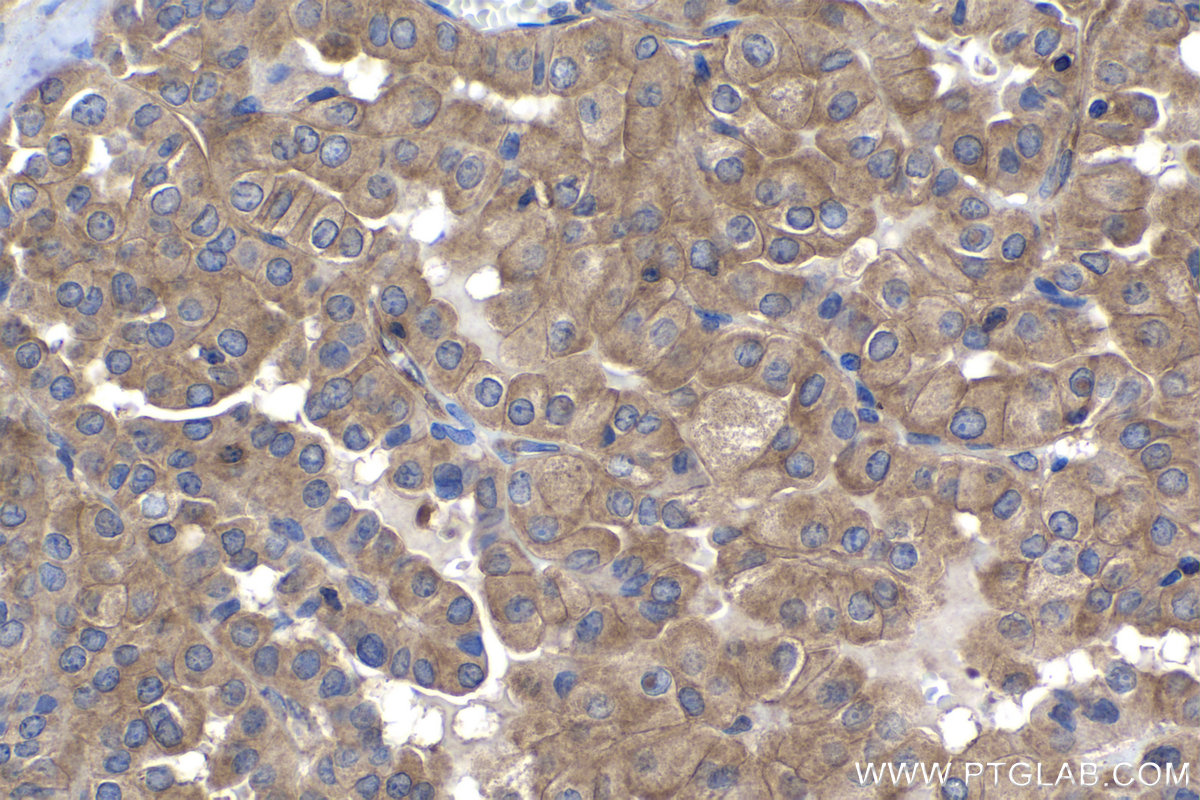 Immunohistochemistry (IHC) staining of human thyroid cancer tissue using PPP3CA Monoclonal antibody (68163-1-Ig)